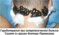 Использование пиявок, гирудотерапия при гипертонии Красноярск Использование пиявок, гирудотерапия при гипертонии Красноярск
